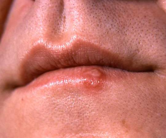 Can Oral Herpes Be Spread To Genitals Planned Parenthood Advocates Of Arizona Can Oral Herpes Be Spread To Genitals Planned Parenthood Advocates Of Arizona